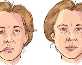 Мимическая гимнастика при неврите, парезе, нейропатии лицевого нерва – убираем недуг навсегда