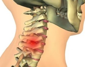 7 лучших упражнений для лечения грыжи шейного отдела позвоночника