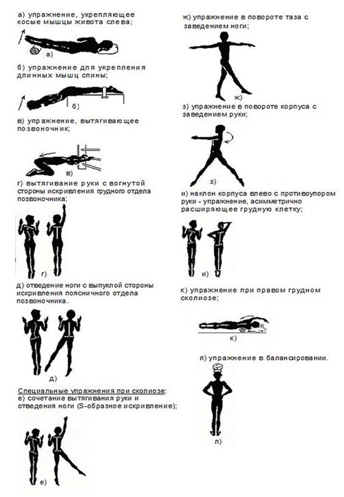 ЛФК при сколиозе: комплекс упражнений для исправления осанки