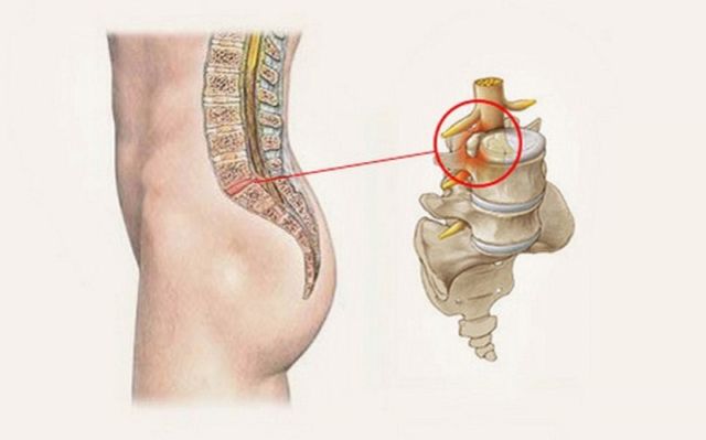 Лечебная гимнастика при протрузиях поясничного отдела позвоночника - лучший комплекс