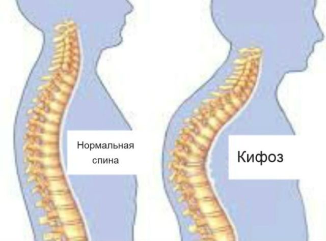 Гимнастика при кифозе грудного отдела позвоночника - лечение упражнениями