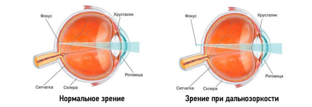 Восстановление зрения при возрастной дальнозоркости: упражнения для глаз
