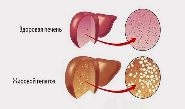 Ожирение печени: причины заболевания и лечение