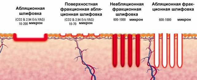 Как работает лазер