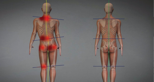 Перекос таза: упражнения для восстановления симметрии тела